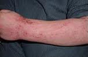 Transfer Faktor Otzyvy pri atopicheskom dermatite
